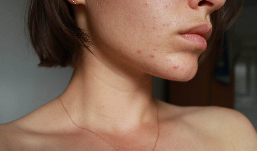 A Woman’s Wellness Expert Shares 5 Tips To Reduce Hormonal Acne