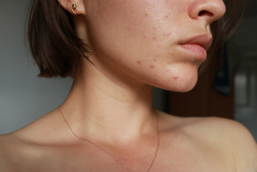 A Woman’s Wellness Expert Shares 5 Tips To Reduce Hormonal Acne