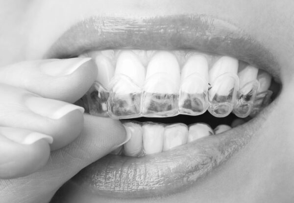 The Do’s & Don’t’s Of Getting Your Teeth Done