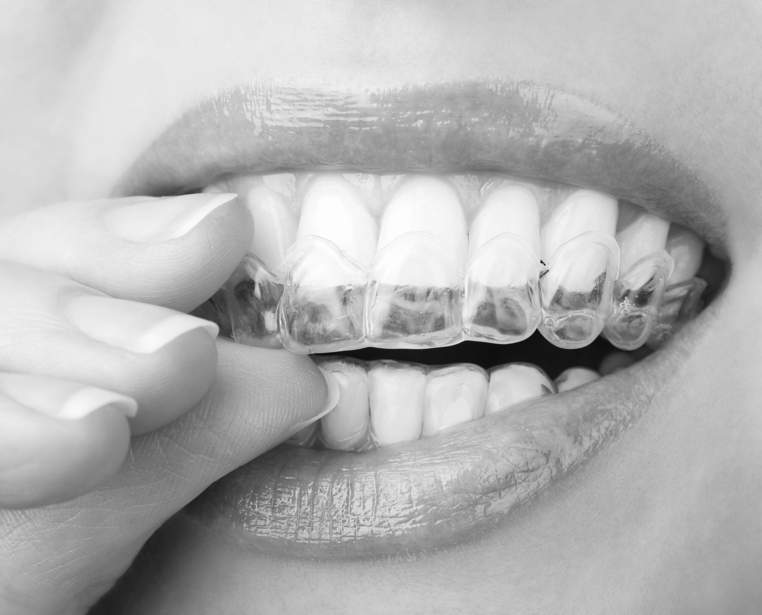 The Do’s & Don’t’s Of Getting Your Teeth Done